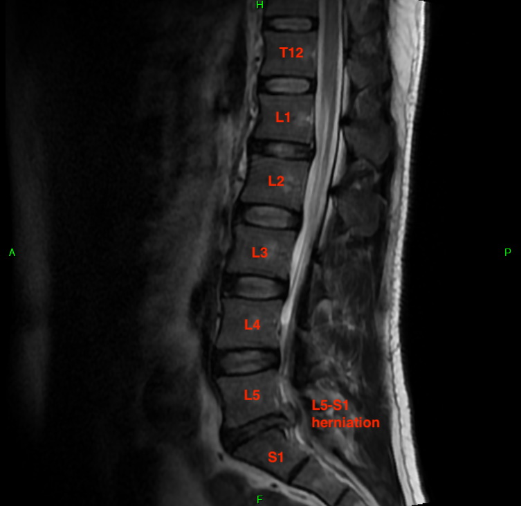(Sagittal MRI)